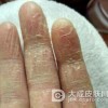 手癣带来的影响有哪些呢