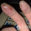 哪些人容易患上手癣