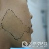 婴儿咖啡斑能不能治好