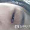 女性咖啡斑治疗的方法都有哪些