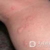 麻疹样红斑型药疹护理的重点