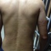 难言外阴湿疹如何预防
