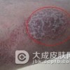 外阴湿疹怎么预防？