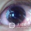 眼睑带状疱疹的表现特征有哪些