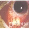 眼睑带状疱疹的常用治疗方法