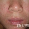 染发皮炎的护理措施都有什么呢