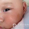 咖啡斑治疗后的注意情况分析
