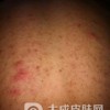 到底要如何对毛囊炎进行护理呢