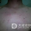 对抗毛囊炎不能吃哪些东西