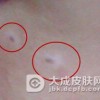 晕痣患者的护理常识