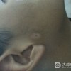 如何做好晕痣患者的面部护理