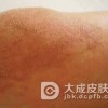 药疹多长时间能好