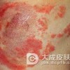 药疹防治的需要加以注意有哪些