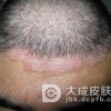 导致头癣加重的原因有哪些
