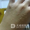 如何诊断自己是否患了汗疱疹？