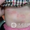 病毒性疱疹是什么
