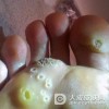 怎样跖疣症状进行诊断