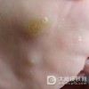 预防跖疣的方法有哪些