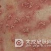 银屑病疾病患病的原因