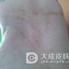 疥疮患者的日常行为指导