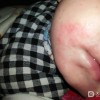 慢性湿疹吃什么药物呢