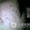 健康饮食可以去除顽固粉刺吗