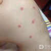 亚急性皮肤型红斑狼疮能活多久？