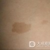 激光怎么治疗咖啡斑