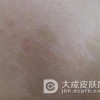 解析咖啡斑的激光治疗