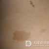 咖啡斑怎么治比较好