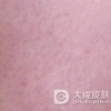 药物性皮炎具有的特点有什么