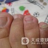灰脚指甲的治疗方法有哪些