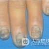 哪些原因会引起灰指甲