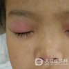 皮肌炎的发病原因有哪些呢