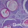 毛发上皮瘤要注意什么