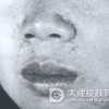 毛发上皮瘤有什么预防保健