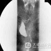 有关巴雷特食管的鉴别