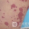 小儿过敏性紫癜发病症状有哪些