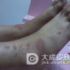 小儿过敏性紫癜怎么确诊