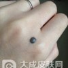 这一类痣其实相当危险