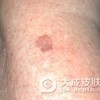 继发性女阴过度角化会引发什么疾病