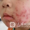 如何有效进行预防小儿脓包疮