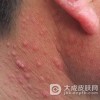 多形性日光疹患者的护理需要注意什么