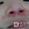 脓包疮是什么引起的