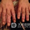 新生儿脓疱疮的病因