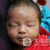 新生儿脓疱疮的发病机制是什么呢