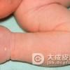 脓疱疮有哪些特殊类型呢