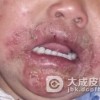 脓疱疮的诊断方法是什么呢