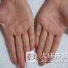 弥漫性掌跖角化病是什么样子的
