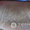 弥漫性掌跖角化症的症状有哪些